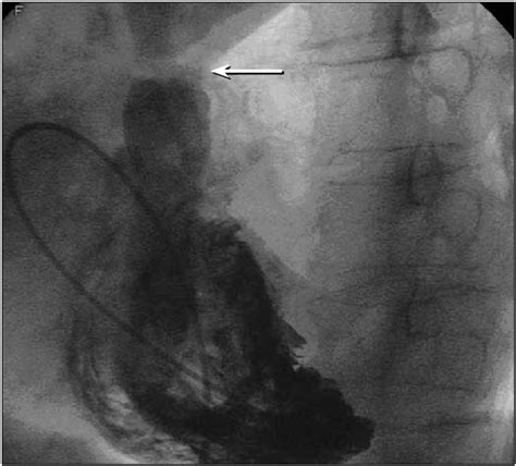 Right Ventricular Angiogram Clearly Showing Pulmonic Stenosis Arrow