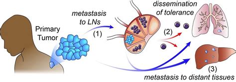 Cancer in Lymph Nodes May Help Tumors Metastasize - NCI