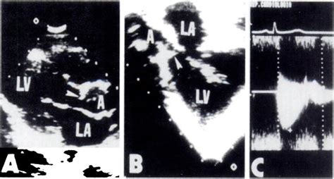 Discrete Subaortic Stenosis Chest