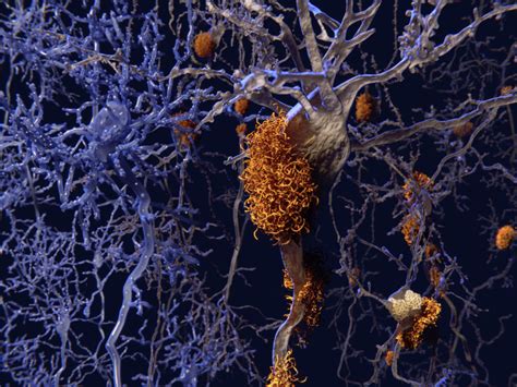 Single Cell RNA Sequencing Uncovers New Culprit In Alzheimer S Disease