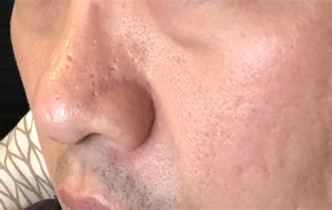 Raised Acne Scar On Nose