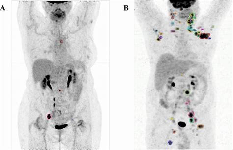 Total Metabolic Tumour Volume Tmtv And Whole Body Total Lesion