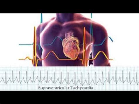 Supraventricular Tachycardia | SVT - types , symptoms, management | Supraventricular tachycardia ...