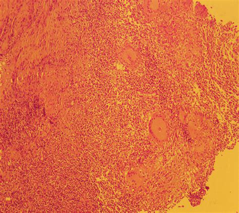 Photomicrograph With H And E 10 Showing A Granuloma Scanty