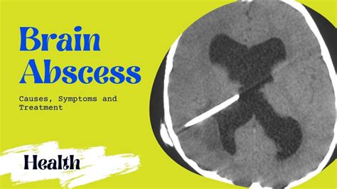 Brain Abscess Causes Symptoms And Treatment [full] 2024