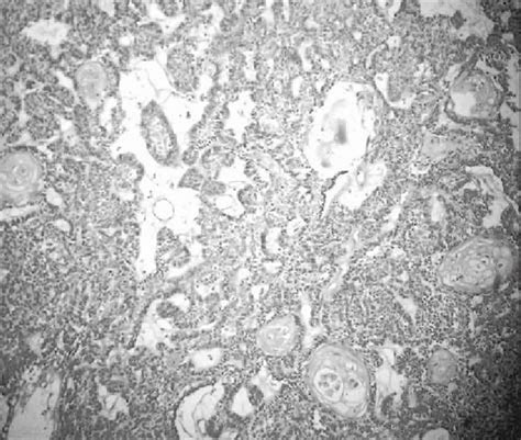 Interconnecting Strands And Nests Of Basaloid Cells With Interspersed