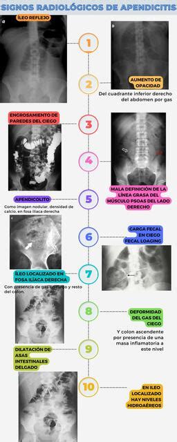 Signos Radiológicos Apendicitis Merilee Flores Paredes Udocz