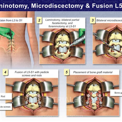 Laminotomy Microdiscectomy And Fusion L5 S1 Trialquest Inc