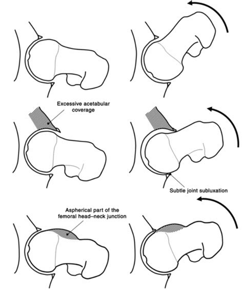 Fai Vancouver Hip Institute Hip Preservation Vancouver Bc