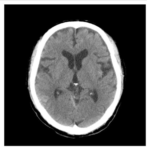 Head Ct 3 H After Admission Showed The Expansion Of The Temporal Lobe