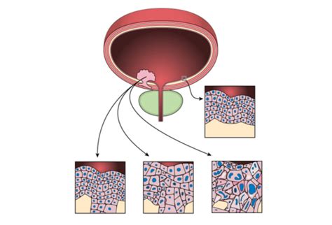 Lenfortumab Vedotin Dans Le Carcinome Uroth Lial Avanc Progressant