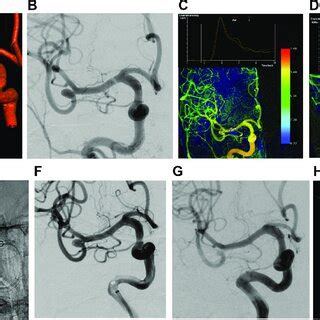 A B Digital Subtraction Angiography Dsa And Dimensional Dyna Ct