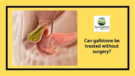 Can Gallstone Be Treated Without Surgery Is Gallbladder Removal Surgery The Only Solution