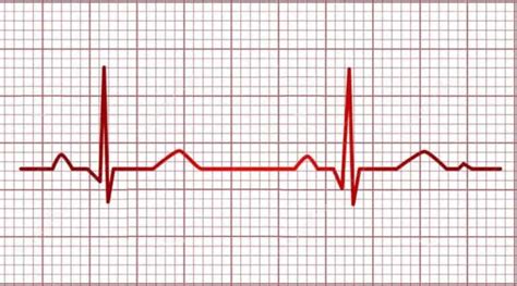 La Importancia De Hacerte Un Electrocardiograma CEEAD Laboratorios