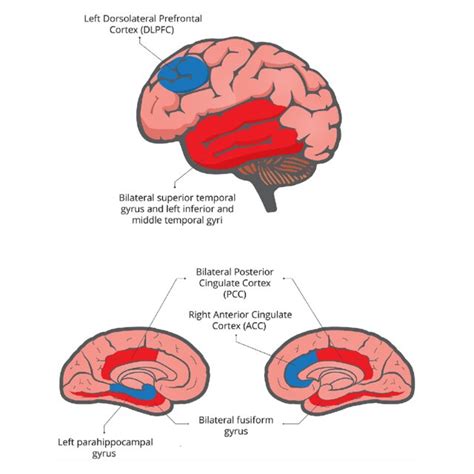 A Deluded Brain General Alterations Of Brain Activity In Delusional