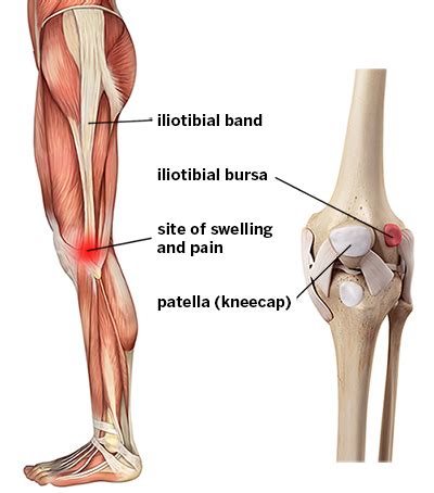 It Band Syndrome Iliotibial Band Syndrome Itbs Labeled Innovative