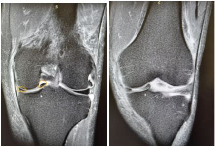 Suture R Paration M Niscale Sous Arthroscopie Dr Kamal Haoudi Blog