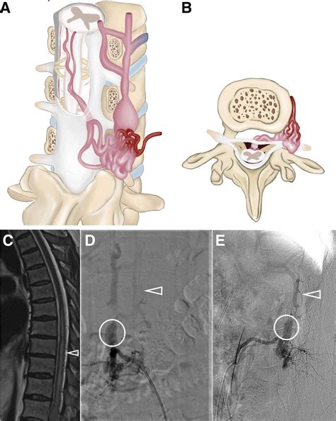 Natural History And Clinical Outcomes Of Paravertebral Arteriovenous