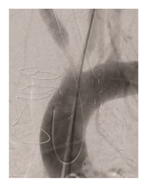 A Baseline Angiogram Of Severe Stenosis Of The Innominate And Left