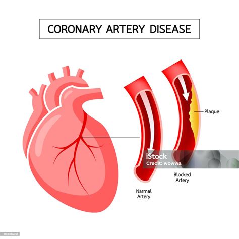 人的心臟與冠狀動脈疾病的資訊圖形向量圖形及更多各種病症圖片 各種病症 冠狀動脈 動脈 血管 Istock
