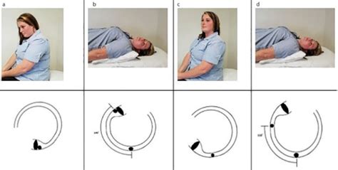 Modifications Of The Dix Hallpike Test For Bppv Hearing Health