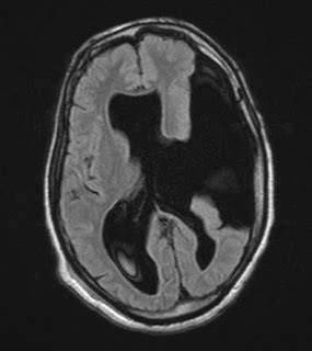 RadiologySpirit: Schizencephaly