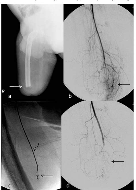 Figure 2 From Role Of Endovascular Embolization In Treatment Of Acute