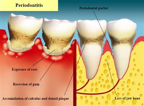 Oral Diseases Oral Health Care Zone For Grown Ups