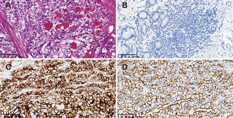 Pathological Findings Of The Surgical Specimen A Hematoxylin And Eosin