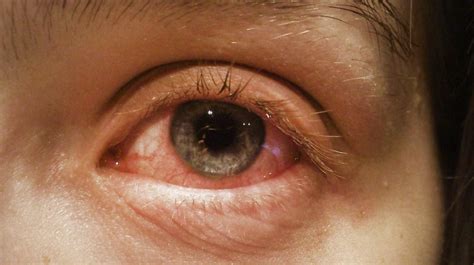 Pink Eye Symptoms Causes Treatment