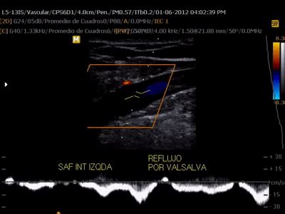 Accuvix V Eco Doppler Venoso De Miembros Inferiores On Make A