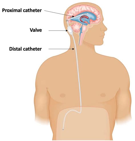 Neuronavigation And Laparoscopy Guided Ventriculoperitoneal Shunt