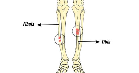 Lower Leg Fractures - Sportsinjuryclinic.net