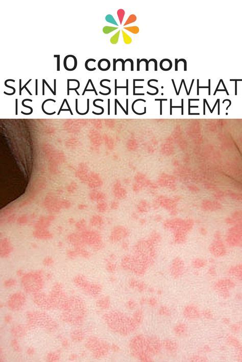 Common Skin Rashes