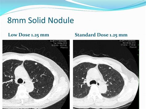 Ppt Low Dose Ct Screening For Lung Cancer Powerpoint Presentation