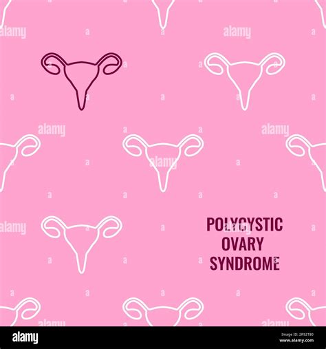 Polycystic Ovary Syndrome Awareness Conceptual Illustration Stock