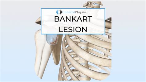 Bankart Lesion Clinical Physio Membership