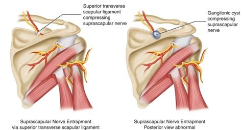 Suprascapular Ligament