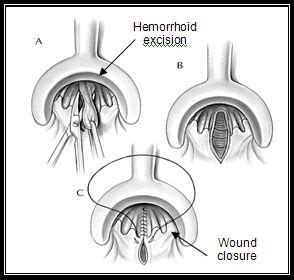 Hemorrhoidectomy Ucsf Robotic Surgery