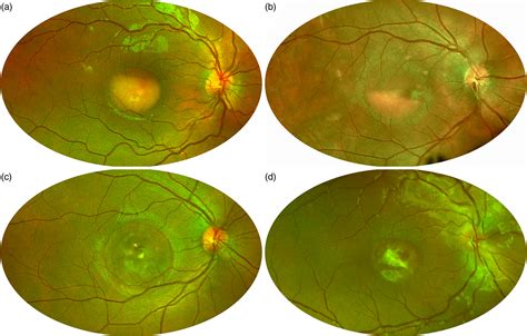 Multimodal Imaging In Best Vitelliform Macular Dystrophy Literature