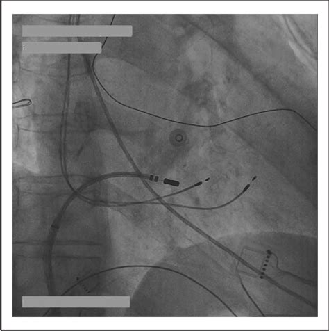 Figure 3 From His Purkinje Conduction System Pacing And