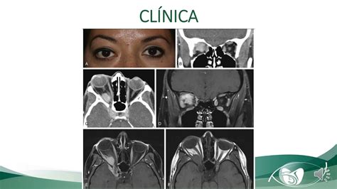 Ocp Meningioma Del Ala Mayor Del Esfenoides Youtube