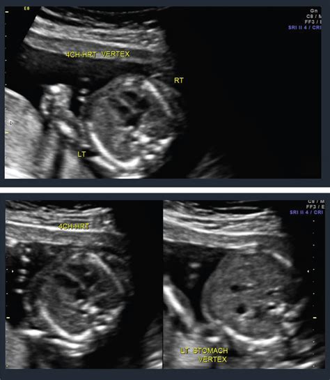 Choroid Plexus Cyst Trisomy 18