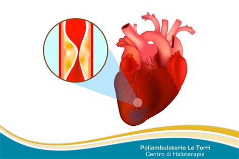 Infarto Miocardico Cause Sintomi E Diagnosi Poliambulatorio Le Torri