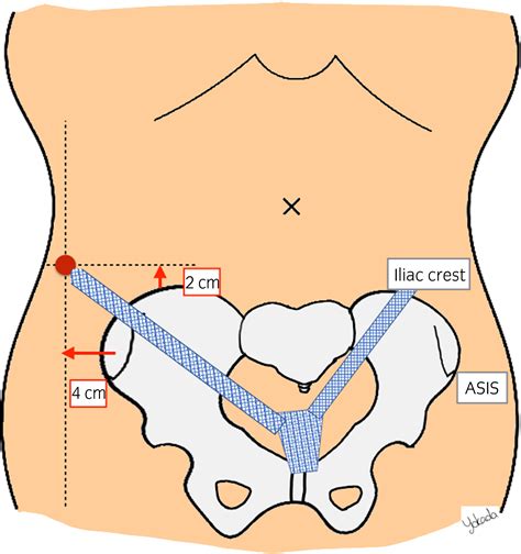 Laparoscopic Lateral Suspension For Pelvic Organ Prolapse In A Case With Difficulty In