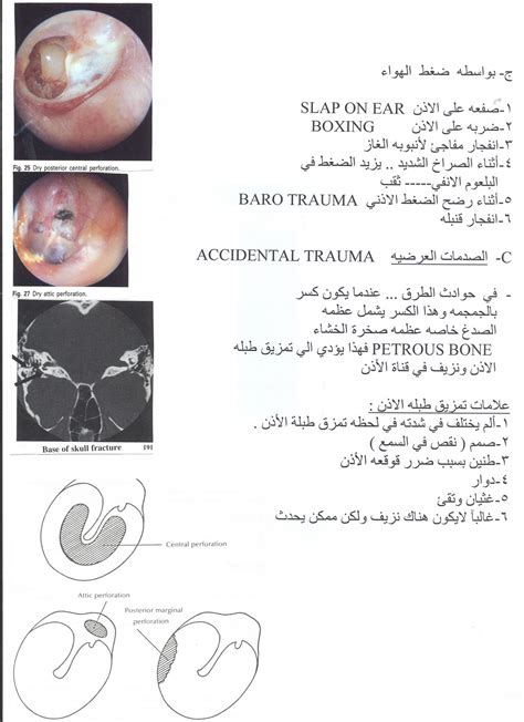 المدونة الطبية دفهيد سالم السبيعي ثقب طبلة الاذن نتبجة اصابات اوحوادث