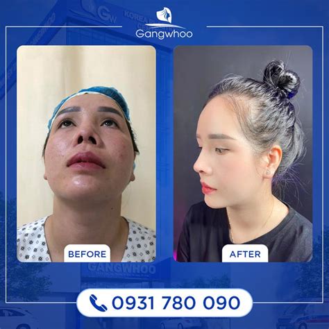 Trong Mũi Có Cục Thịt Dư Và Cách Chữa Trị Tốt Nhất Năm 2023 Thẩm Mỹ