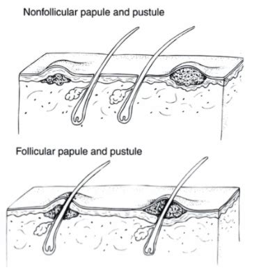 Approach To Papular Pustular Dermatoses Flashcards Quizlet