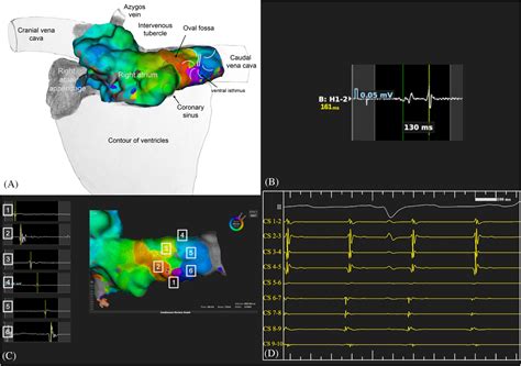 Detection Of The Origin Of Atrial Tachycardia By D Electroanatomical