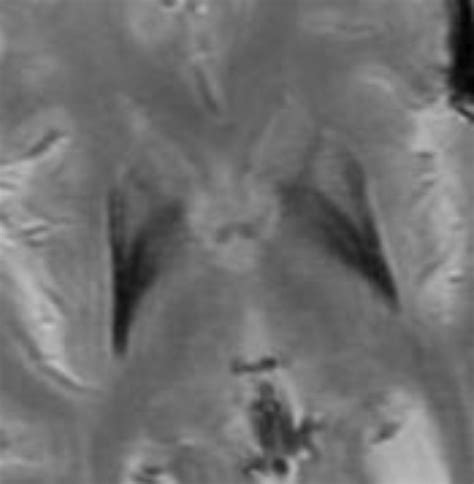 July 2, 2012 - Case of the Week | American Journal of Neuroradiology